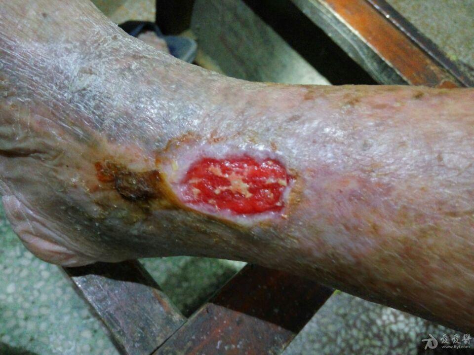 老烂腿最新疗法，重塑自信，迈向新生活