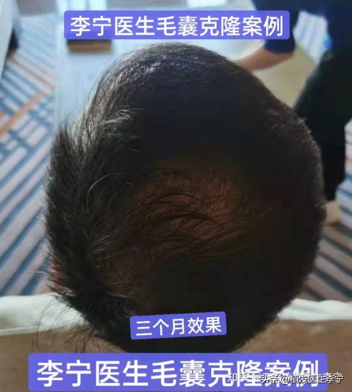 毛囊移植技术最新进展，重塑自信，从头开始重塑人生自信毛囊移植技术更新动态