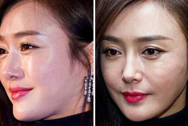 玻尿酸明星，科技重塑美丽，开启新纪元的光辉之路